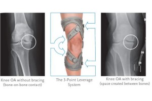 What is knee osteoarthritis (OA)?